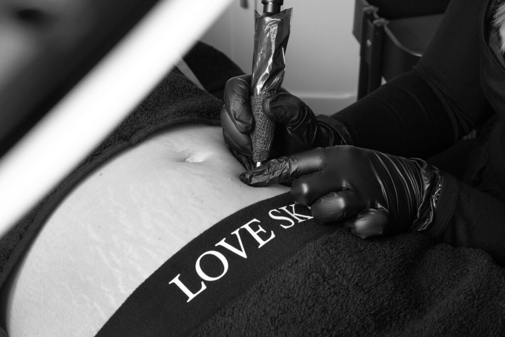 love skin with aydan cosmetic tattoo scar reduction